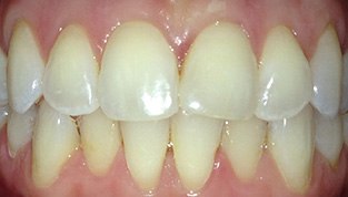 white, clean teeth after procedure