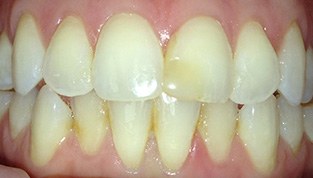 discolored teeth before procedure