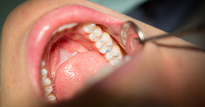 Tooth examined after filling placement