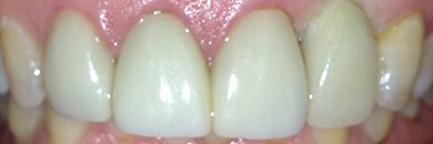 top teeth after porcelain veneers