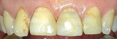 discolored top teeth before procedure 