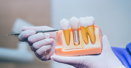 a dentist in Bristol explaining how dental implants work