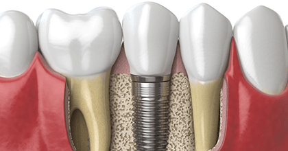 a 3D illustration of a dental implant and abutment