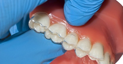 clear aligner over teeth