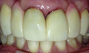 smile after dental implants