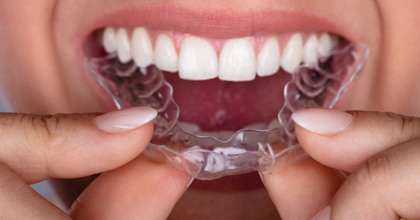 woman inserting clear aligner