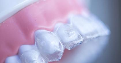 clear aligner over teeth