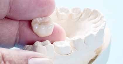 Model of a dental crown