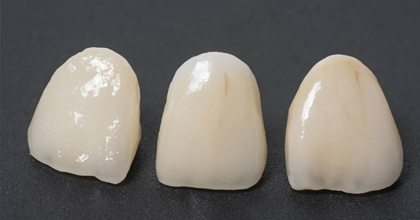 dental restoration