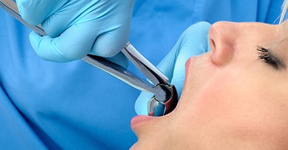 Closeup of patient having tooth extracted