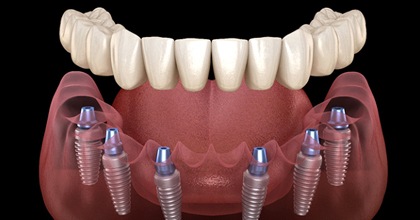 Illustration of implant dentures for lower arch against dark background