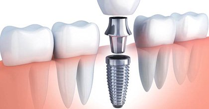 single dental implant with abutment and crown