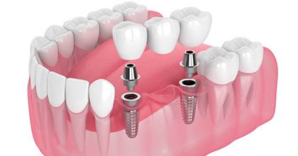 two dental implants supporting a dental bridge 