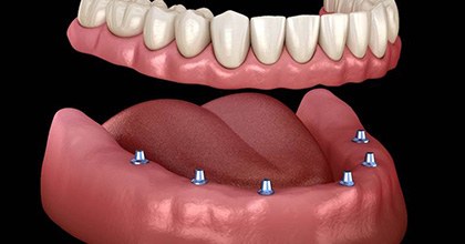 six dental implants supporting a full denture