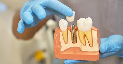 dentist putting a crown on a dental implant