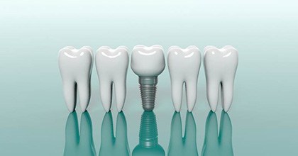 dental implant in the middle of models of natural teeth 