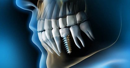 X-ray of a person with a dental implant in the lower jaw 