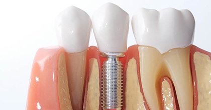 dental implant with crown in a model of the jaw