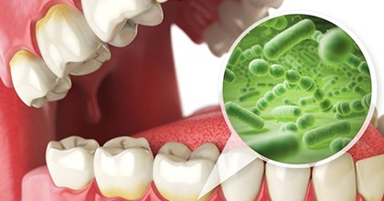 Illustration of bacteria around gumline