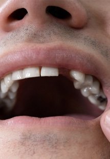 patient pointing to gap in his smile 