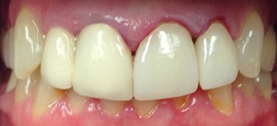 Smile after dental procedure