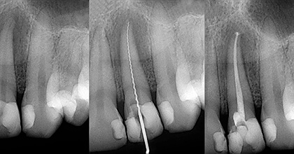 X-ray of root canal treated tooth