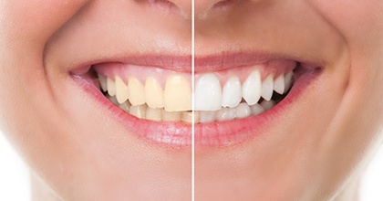 before and after whitening