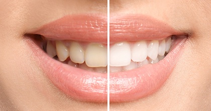 Before and after teeth whitening