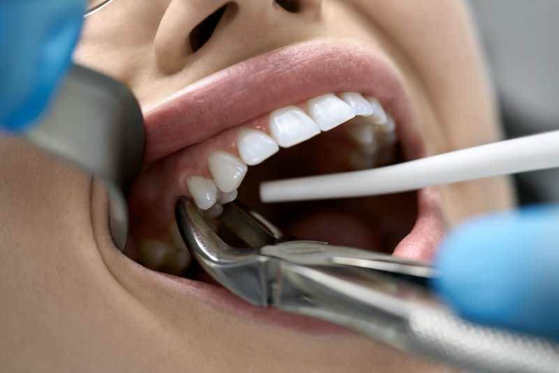 Close-up of a tooth extraction