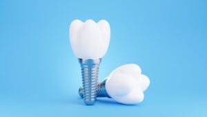 Dental implants against a blue background
